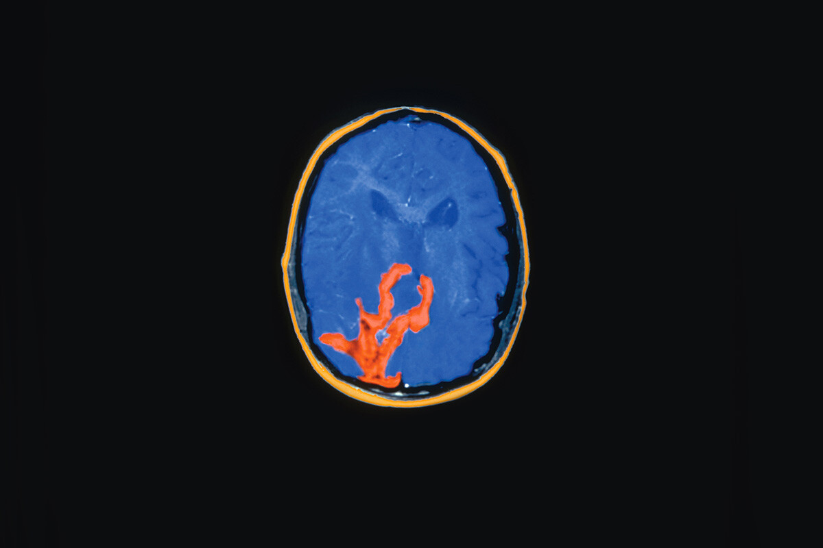 About Malignant Gliomas